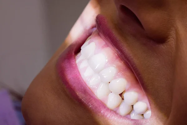 Vrouwelijke Patiënt Ontvangende Tanden Licht Behandeling Bij Tandheelkundige Kliniek Close — Stockfoto