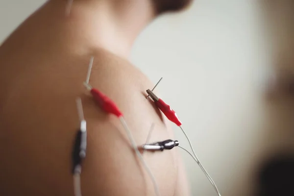 Erkek Hasta Elektro Getting Close Kuru Omzuna Iğneleme Yöntemlerinin Etkinliğinin — Stok fotoğraf