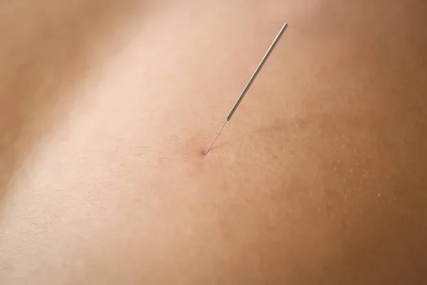 患者の背中に鍼を乾いてのクローズ アップ — ストック写真