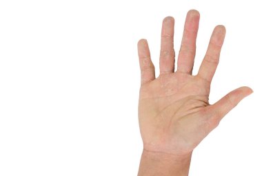 El kuru el, peeling, aşırı duyarlık hallerinde, beyaz zemin üzerine el