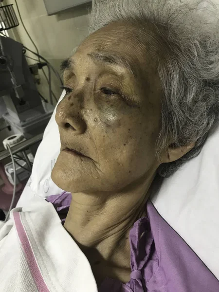 Asiatisk Senior Kvinna Patient Sängen Sjukhuset Virusinfektion Låga Trombocyter Blåmärken — Stockfoto