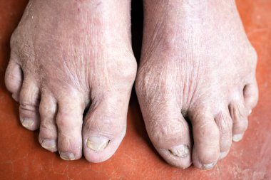Sedef hastalığı, deri iltihabı, ayak parmaklarının kuru derisi, kırık ayak derisi ve onychomycosis hastalığı, Tinea Unguium, yaşlı bir hastanın tırnaklarındaki ayak mantarı enfeksiyonu, sağlık sorunları, yaşlı insanların sorunları.