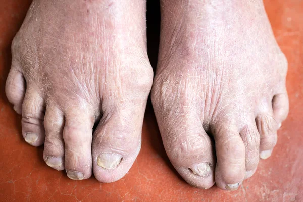 Psoriasis Atopic Dermatitis Dry Skin Toes Cracked Skin Feet Disease — Stock Photo, Image