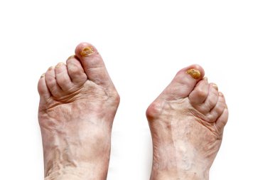 Mantar nedeniyle hasarlı çivi ile bir ayak closeup. Yaşlı kadın bacaklar. Diabetis