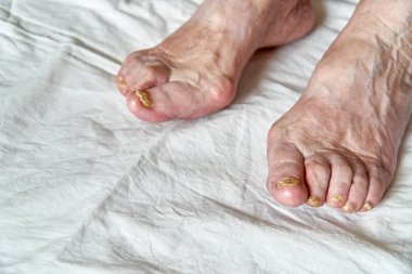 Mantar nedeniyle hasarlı çivi ile bir ayak closeup. Yaşlı kadın bacaklar. Diabetis