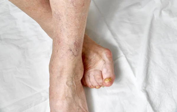 Close-up van een voet met beschadigde nagels vanwege schimmel. Oudere vrouw benen. Diabetes — Stockfoto