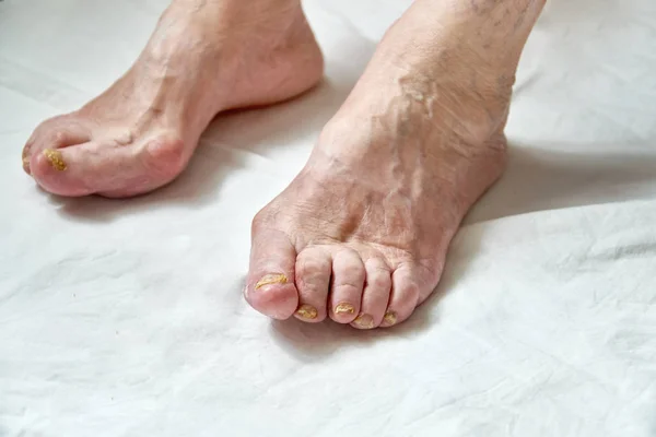 Gros plan d'un pied avec des ongles endommagés à cause d'un champignon. Jambes de femme âgée. Diabète — Photo