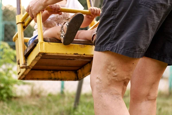 Schmerzhafte Krampfadern und Besenreiser an den Beinen der Frau, die aktiv ist und sich selbst hilft. Gesundheit — Stockfoto