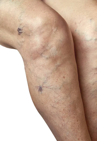 Varicose veins on a female legs. Phlebology — Stock Photo, Image