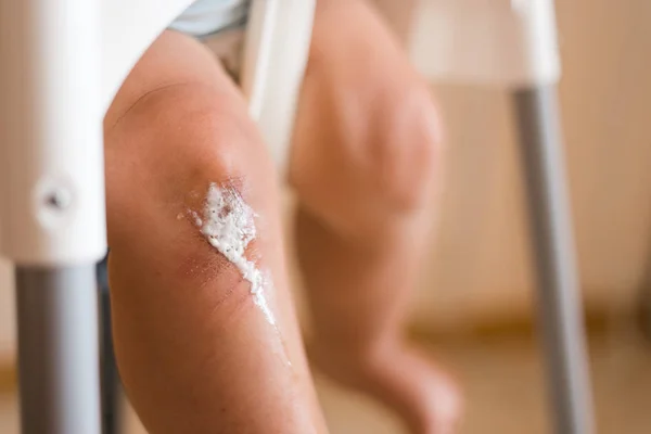 Decontamination and disinfection of the wound on baby knee at home. Close up — Stock Photo, Image