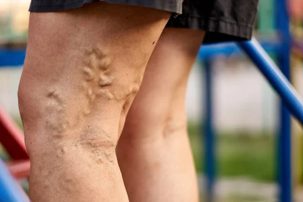 Varicosa dolorosa e veias de aranha em pernas de mulher, que é ativa, auto-ajudando-se. Serviços de saúde — Fotografia de Stock