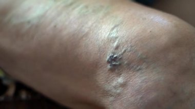 Varisli yaşlı kadın bacağını kapatıyoruz. Yaşam biçimi