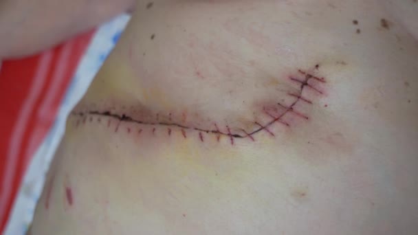Zblízka obézní žena břicho s jizvou a stehy po chirurgické operaci.