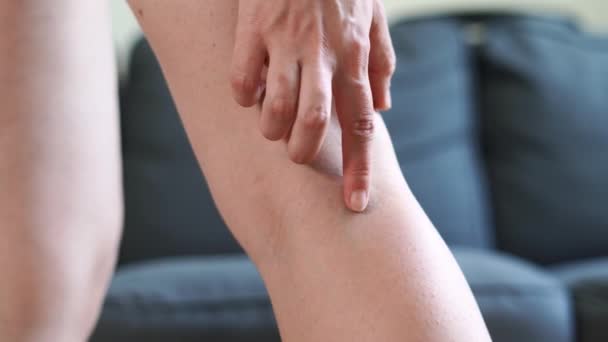 Női láb visszerekkel. Krémes kezelés. — Stock videók