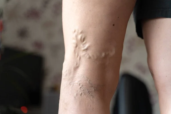 Varicose veins on woman legs indoors. Vascular health problem. Trombose on female legs — Stock Photo, Image