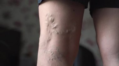 Kadın bacaklarında varis damarları var. Vasküler sağlık sorunu. Dişi bacaklarında tromboz