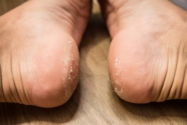 topuk hastalığı yakın