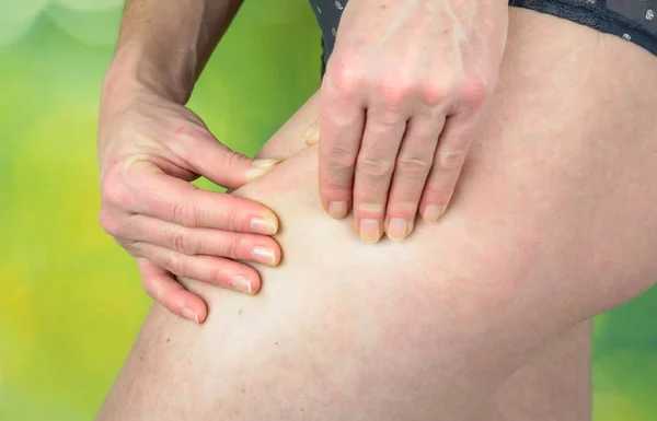 Woman Pinching Leg Skin Fold Test Healthy Lifestyles Concept Green — Stock Photo, Image