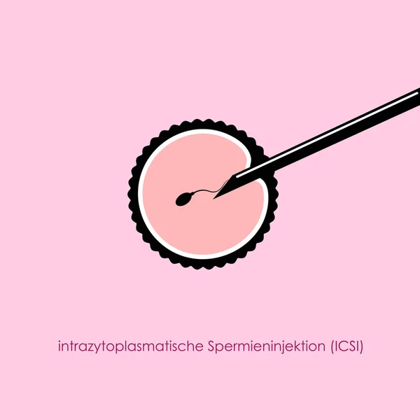 Inseminación artificial del óvulo ICSI con aguja y esperma — Archivo Imágenes Vectoriales
