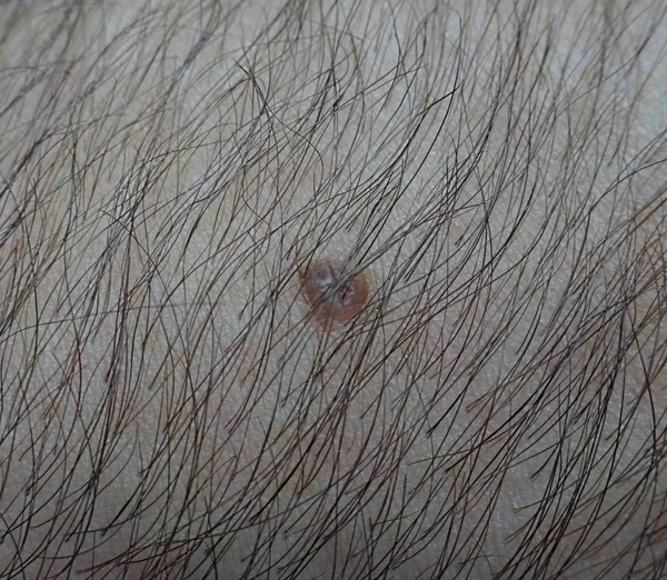 Brown Mole Hairy Arm Skin — Stock Photo, Image