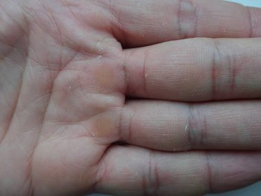 Avuç içi kuru cilt 