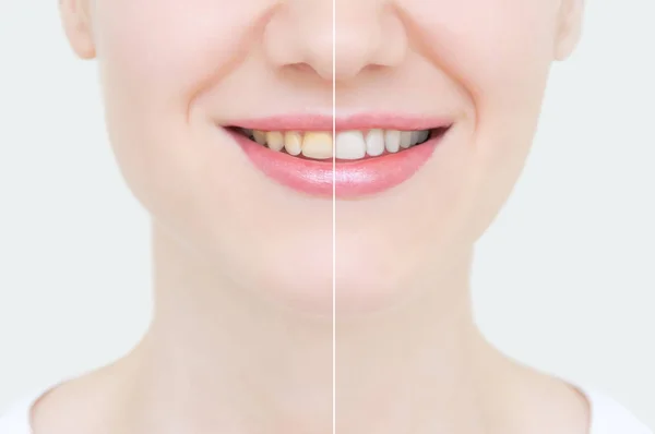 Mükemmel gülümseme öncesi ve sonrası ağartma. Diş Bakımı ve diş beyazlatma. Yüz yakın çekim.