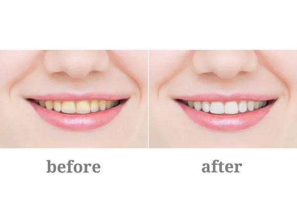 Sarı kaplama yakın çekim sonra diş tedavisi ve beyazlatma dişler. Önce ve sonra.
