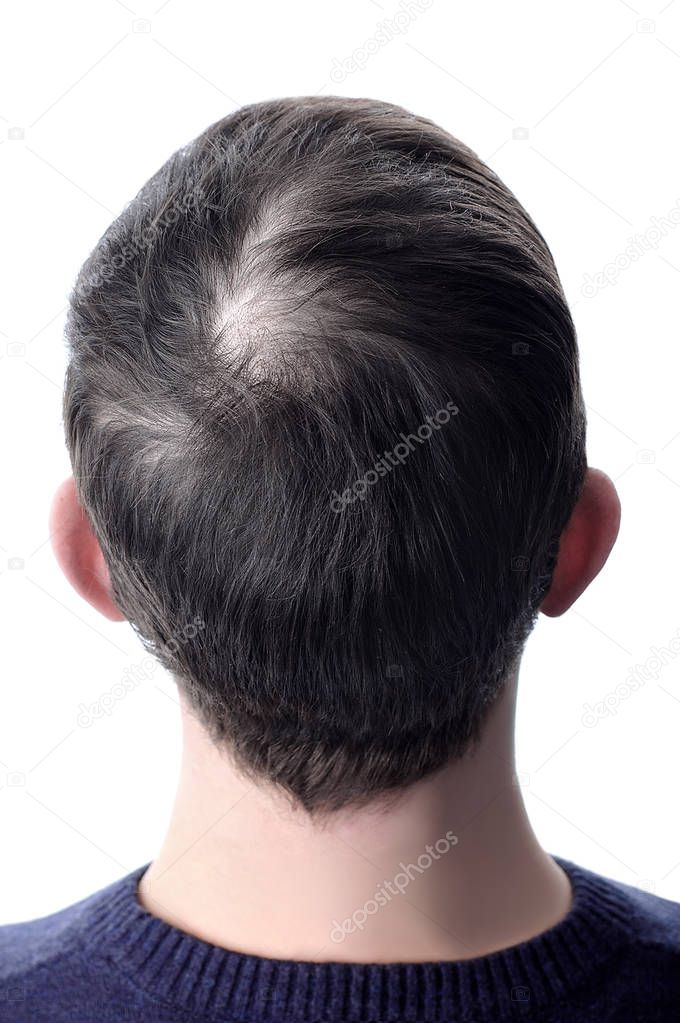 Men's hair with a bald patch before using cosmetic powder to thicken hair. White isolate.