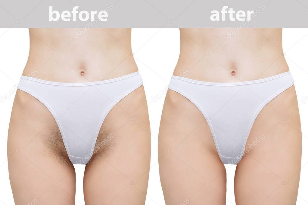 Epilacion Zona Del Bikini Cabello Las Piernas Chica Antes Despues Foto de stock iulal 249649938