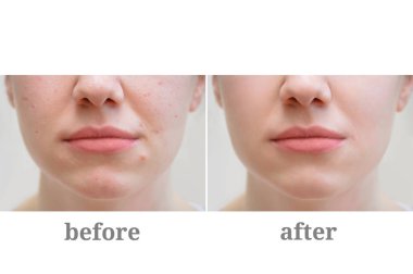 Kızın yüzündeki sivilce. Rosacea tedavisi. Önce ve sonra.