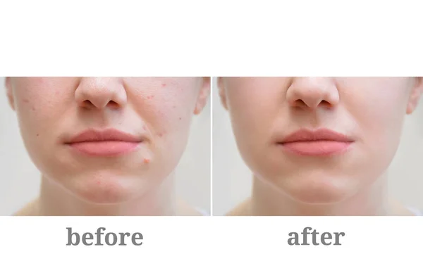 Acne Girl Face Treatment Rosacea — Stock Photo, Image