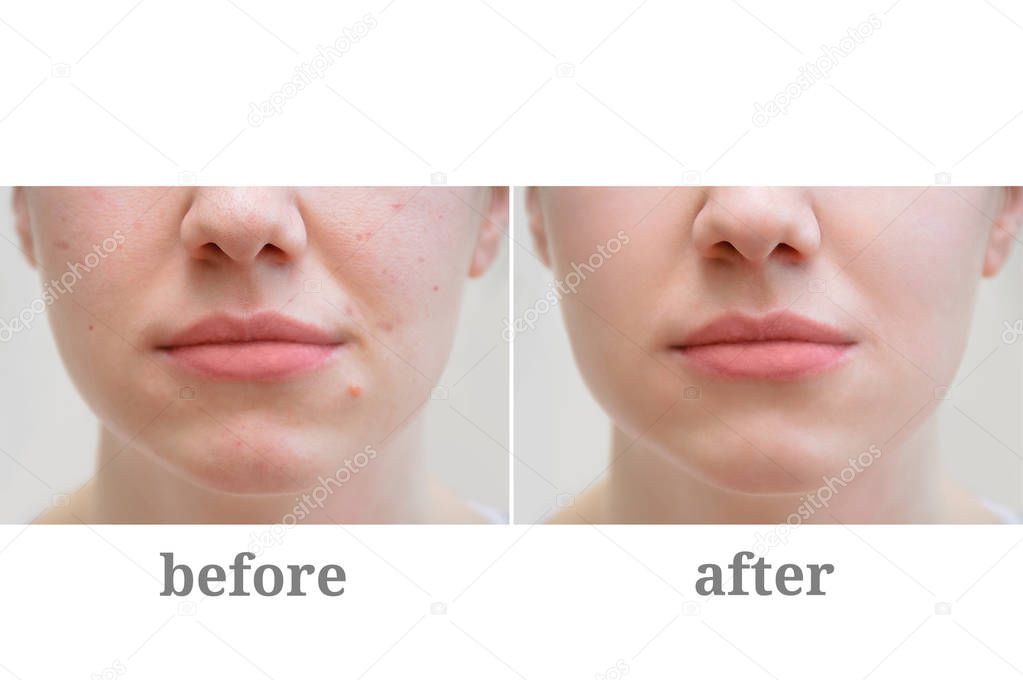 Acne on the girl's face. Treatment of rosacea. Before and after.