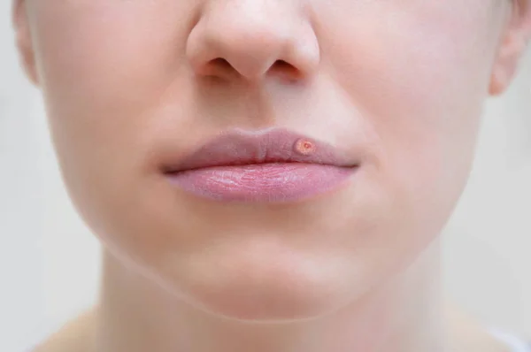 Face Caucasian Girl Close Face Caucasian Girl Closeup Herpes Lips — Stock Photo, Image