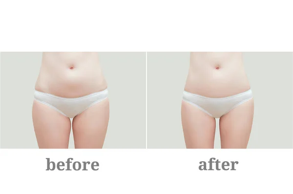 Restablecer Exceso Peso Procedimientos Dieta Pérdida Peso Mujer Gorda Antes —  Fotos de Stock