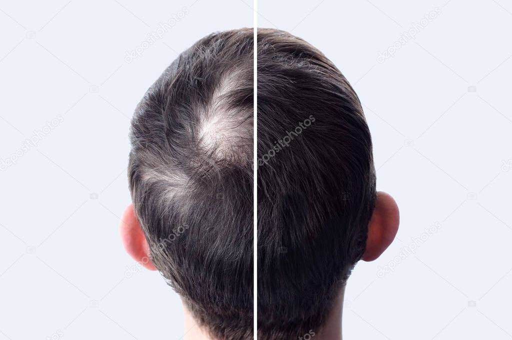 Men hair after using cosmetic powder for hair thickening. Crown with bald head. Before and after.