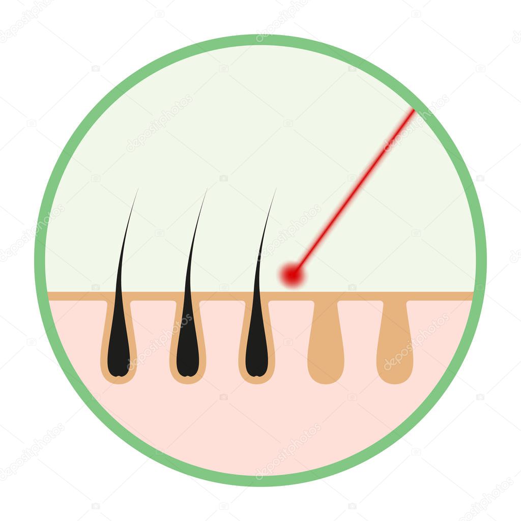 cosmetic laser hair removal