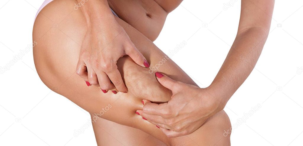 Woman cellulite on thigh squeezed with her hands 