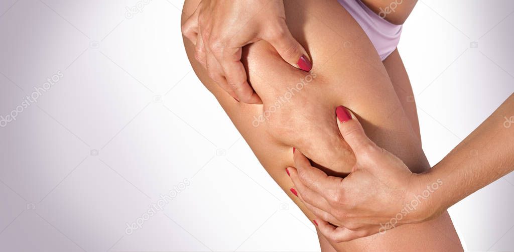 Woman squeezing cellulite on her thigh with hands