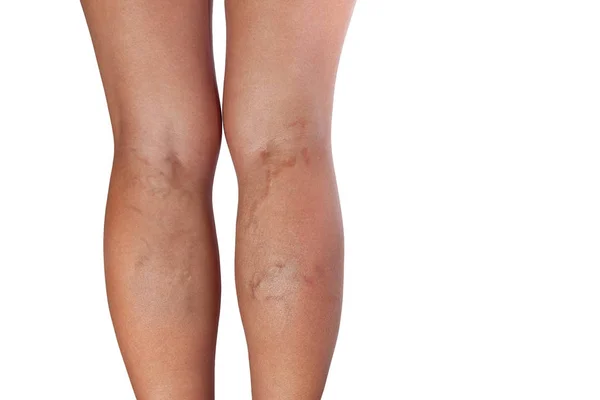 Varicose Veins Woman Legs — Stock Photo, Image