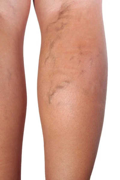 Gros Plan Des Varices Sur Les Jambes Femme — Photo