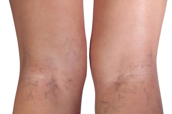 Varices Sur Les Jambes Femme Gros Plan — Photo