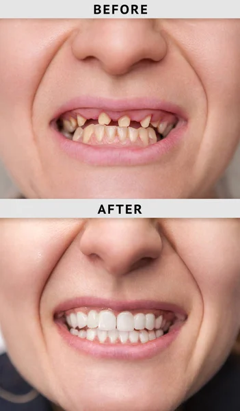 Sorriso Feminino Após Antes Processo Instalação Coroa Dental — Fotografia de Stock