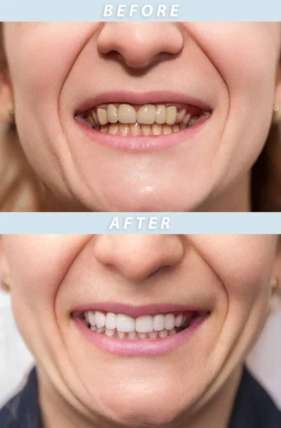 女性の歯歯の治療の前後に 歯を白くします 幸せな笑顔の女性 歯科医療の概念 口腔ケア 歯の修復 — ストック写真
