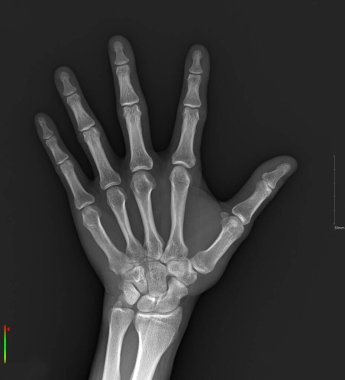The image displays an X-ray of a human hand, showcasing the bone structure. Hand X-rays are used to detect conditions such as fractures, tumors, foreign objects