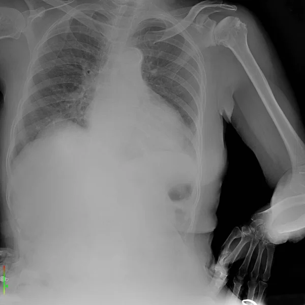 This image shows a human chest X-ray, a common diagnostic tool used in medicine.