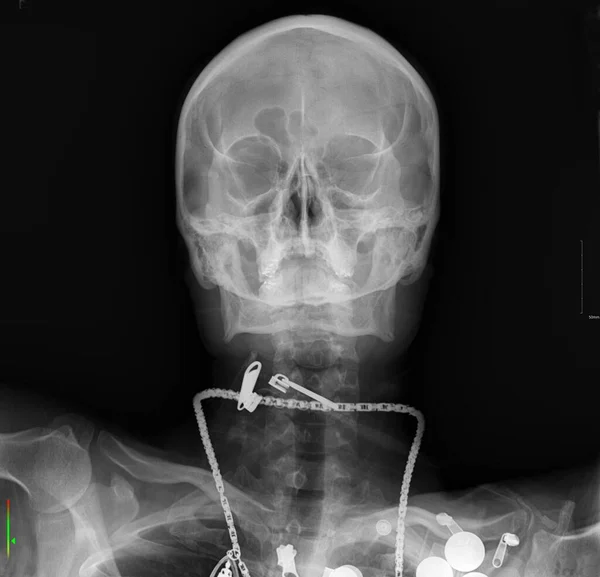 This image shows an X-ray showing the presence of a foreign object.