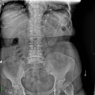 This image is an X-ray of the human torso, showing mostly the spine, ribs, and pelvis.