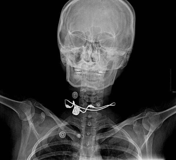 X-ray image showing a foreign body.