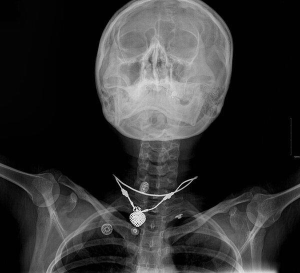 X-ray image showing a foreign body.