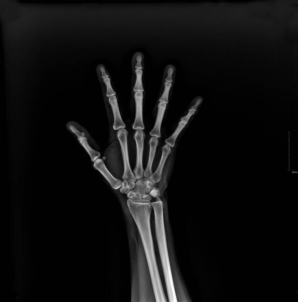 This image is an X-ray of a human hand.